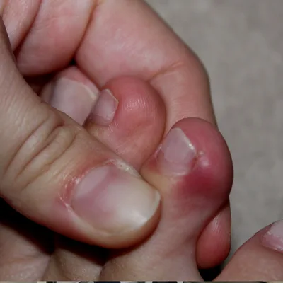 ingrown toenail howell