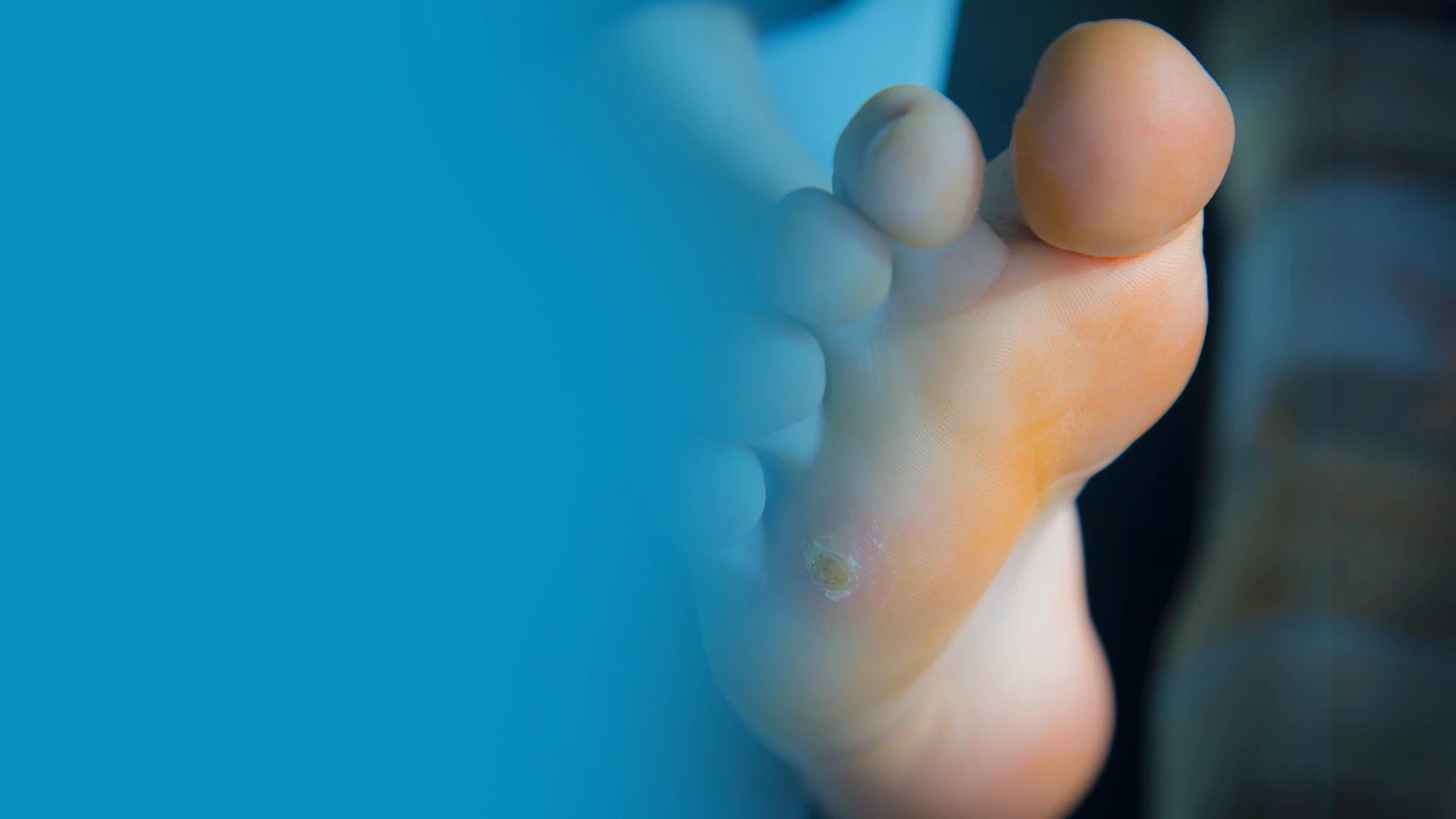 Mortons Neuroma 2 - Balance Foot & Ankle