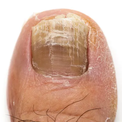 toenail fungus