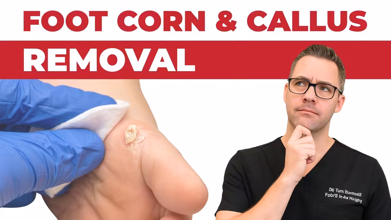 Corn & Callus Removal Howell – Copy | Balance Foot & Ankle