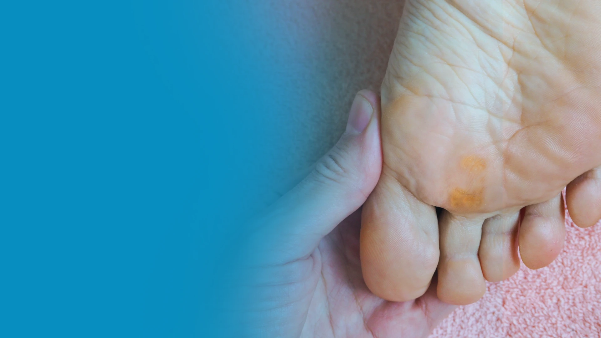 Foot Corn And Callus Removal Bloomfield Hills - Balance Foot & Ankle