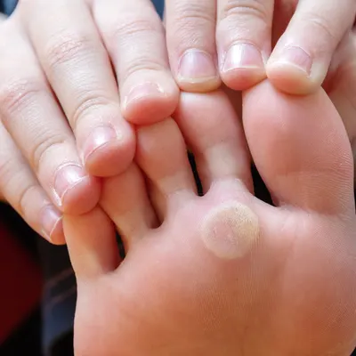 Foot Corn Removal Bloomfield Hills - Balance Foot & Ankle
