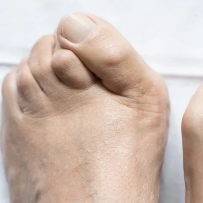 Hammertoe In The Foot (1) | Balance Foot & Ankle