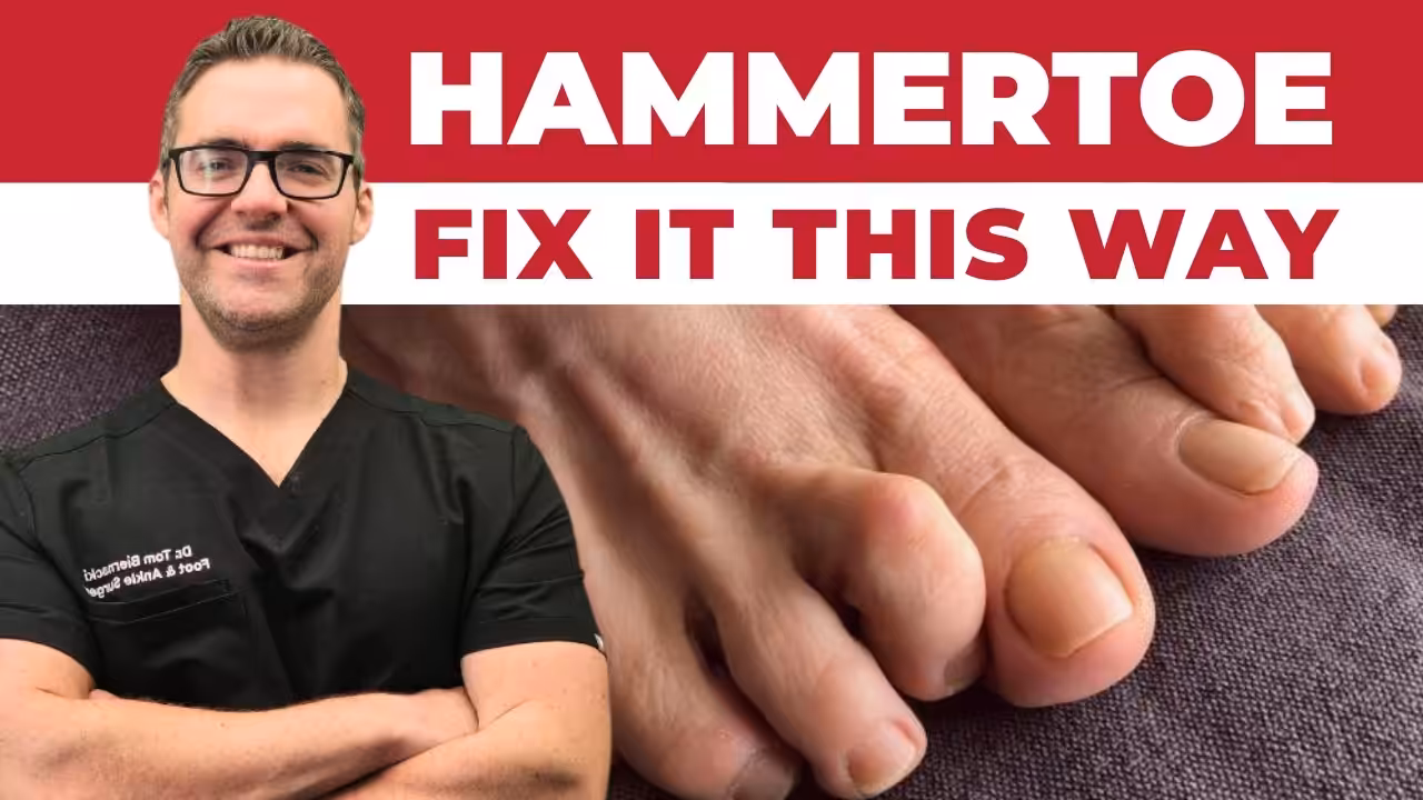 Hammertoe Treatment In Howell Copy - Balance Foot & Ankle