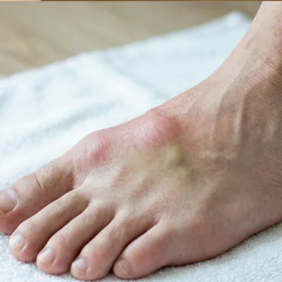 neuropathy treatment