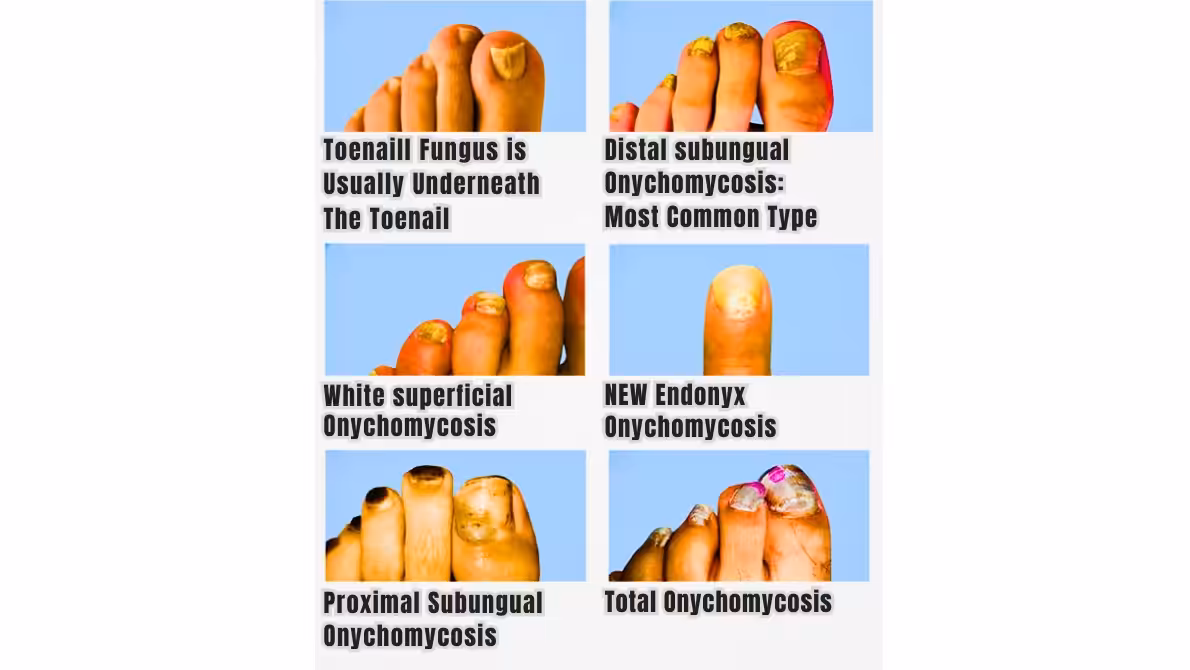 toe-nail-fungus-home-remedy - podiatrist Michigan, Balance Foot & Ankle