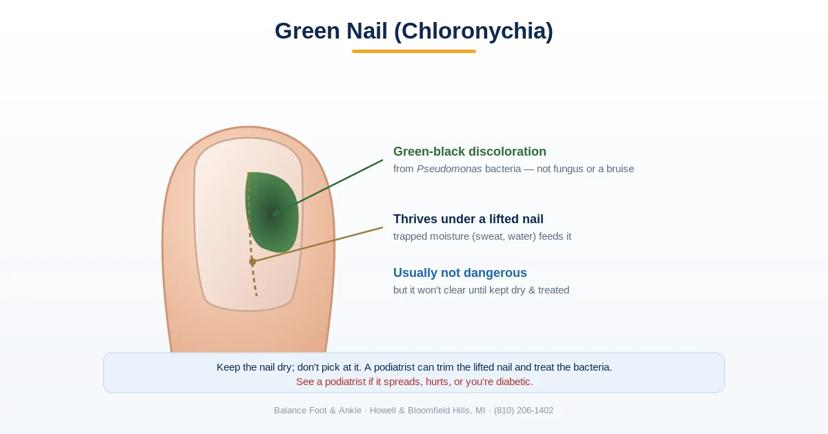 Diagram of green nail syndrome (chloronychia) - green-black discoloration from Pseudomonas bacteria under a lifted nail - Balance Foot & Ankle, Howell MI