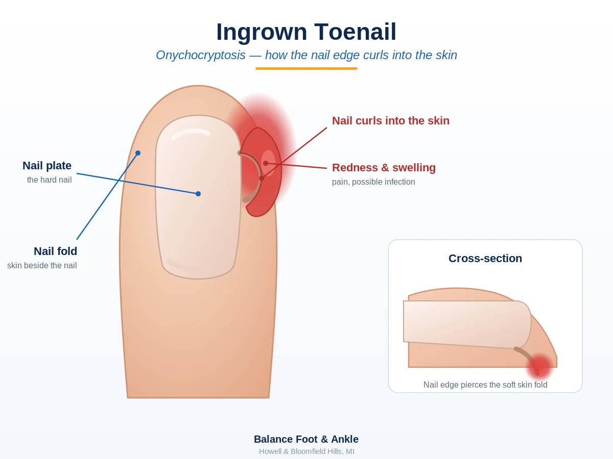 Diagram of an ingrown toenail with the nail edge curling into a red, swollen nail fold - Balance Foot & Ankle, Howell MI