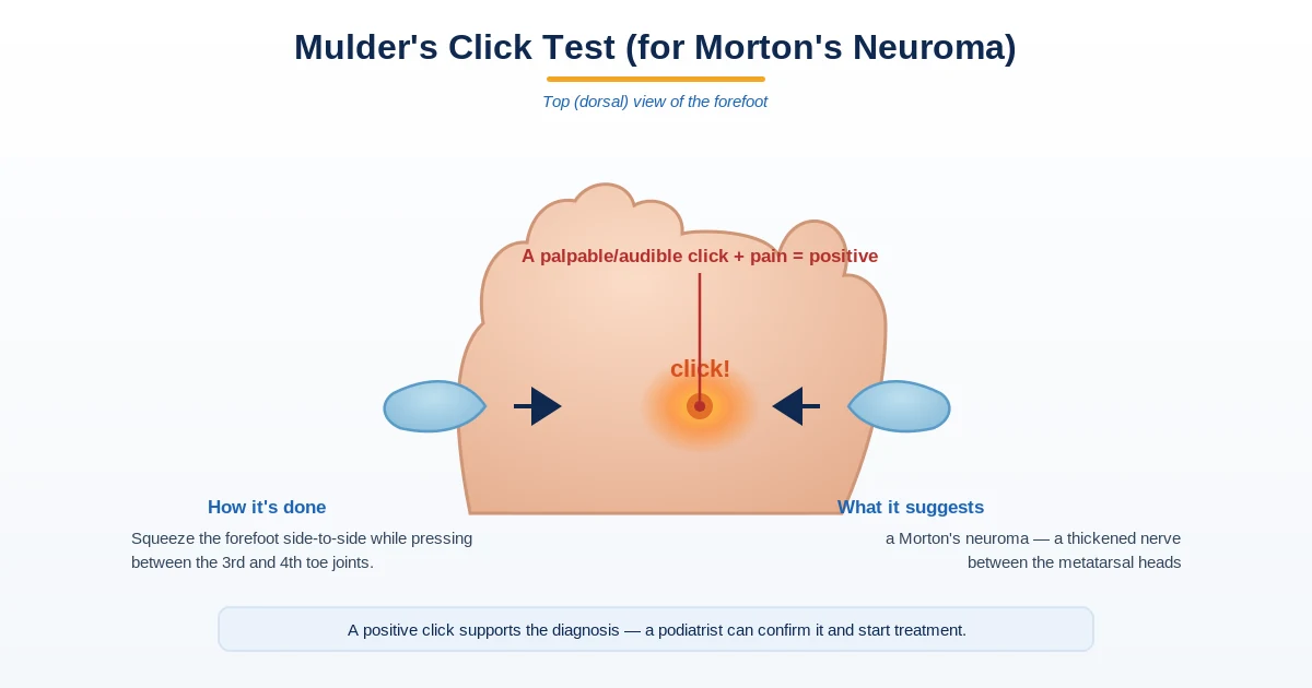 Diagram of Mulder’s click test for Morton’s neuroma - squeezing the forefoot produces a click and pain between the 3rd and 4th metatarsal heads - Balance Foot & Ankle, Howell MI