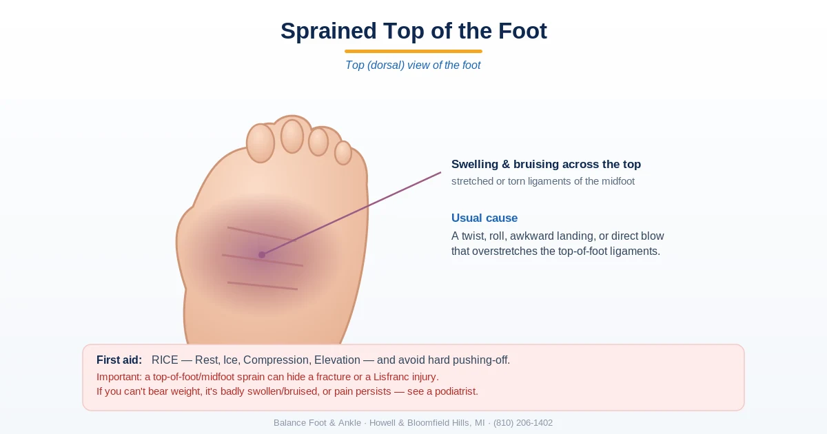 Diagram of a sprained top of the foot - swelling and bruising from stretched midfoot ligaments, with a caution to rule out a fracture or Lisfranc injury - Balance Foot & Ankle, Howell MI