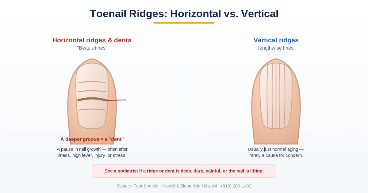 Diagram comparing horizontal toenail ridges and dents (Beau lines) with vertical ridges and what each means - Balance Foot & Ankle, Howell MI