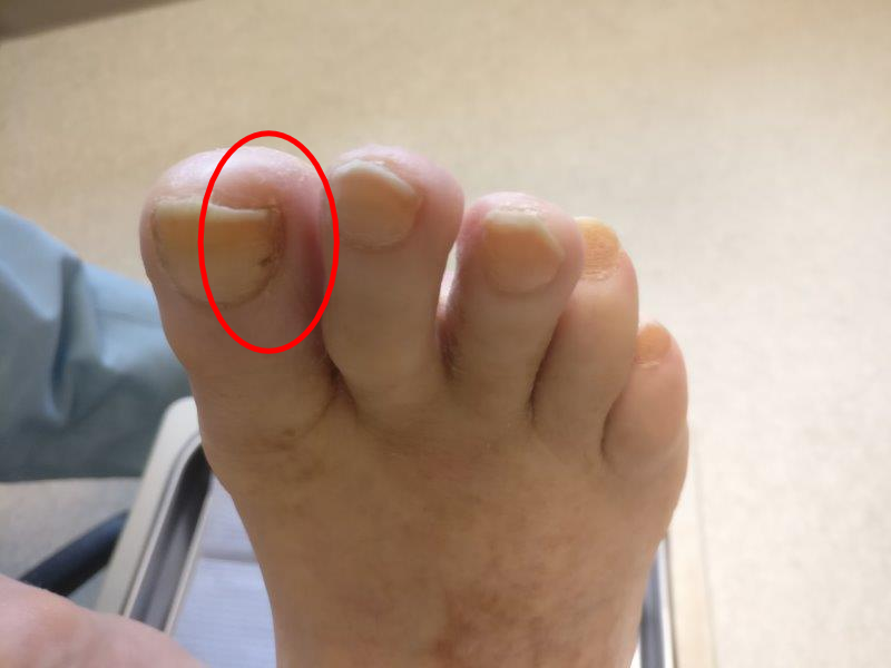 Spot toenail black under When to