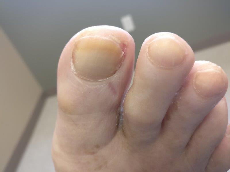 Curved Toenail Treatment - The Complete Ingrown Toenail Guide!