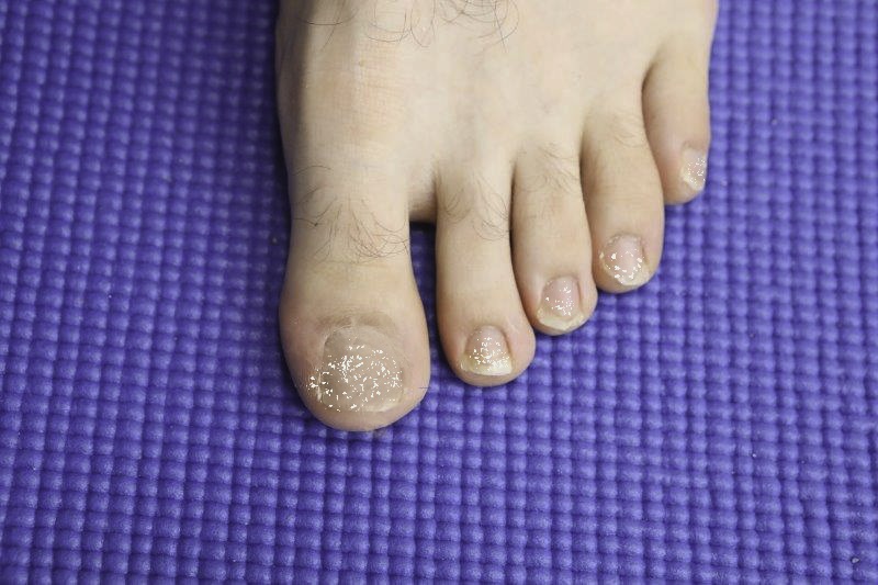 White Patches On Toenails [Causes, Signs & Best Treatment]