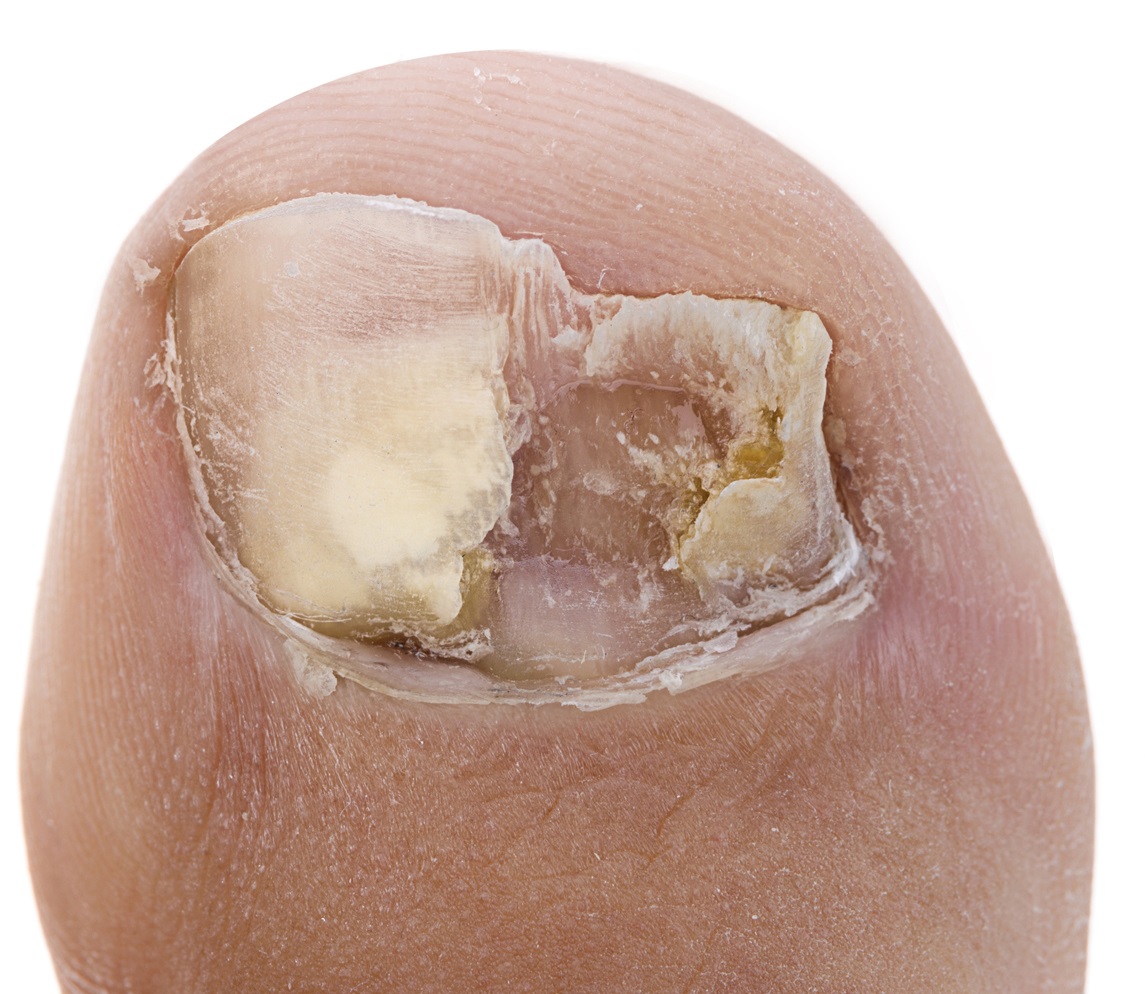 Pseudomonas Nail Infection [Causes, Symptoms & Best Treatment]