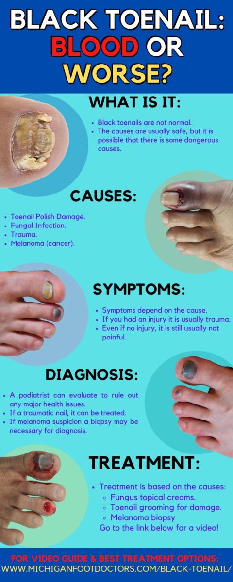 How to get rid of black toenail fungus [Stop black fungus under toenails]