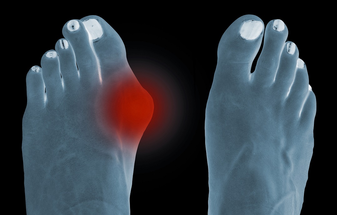 Shooting Pain in Big Toe [Causes, Symptoms & Best Treatment]