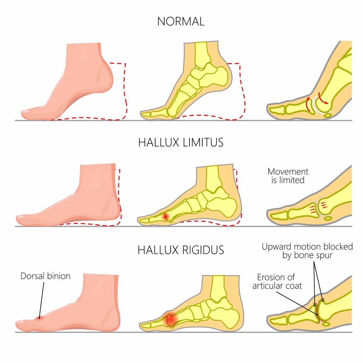 hallux limitus insoles