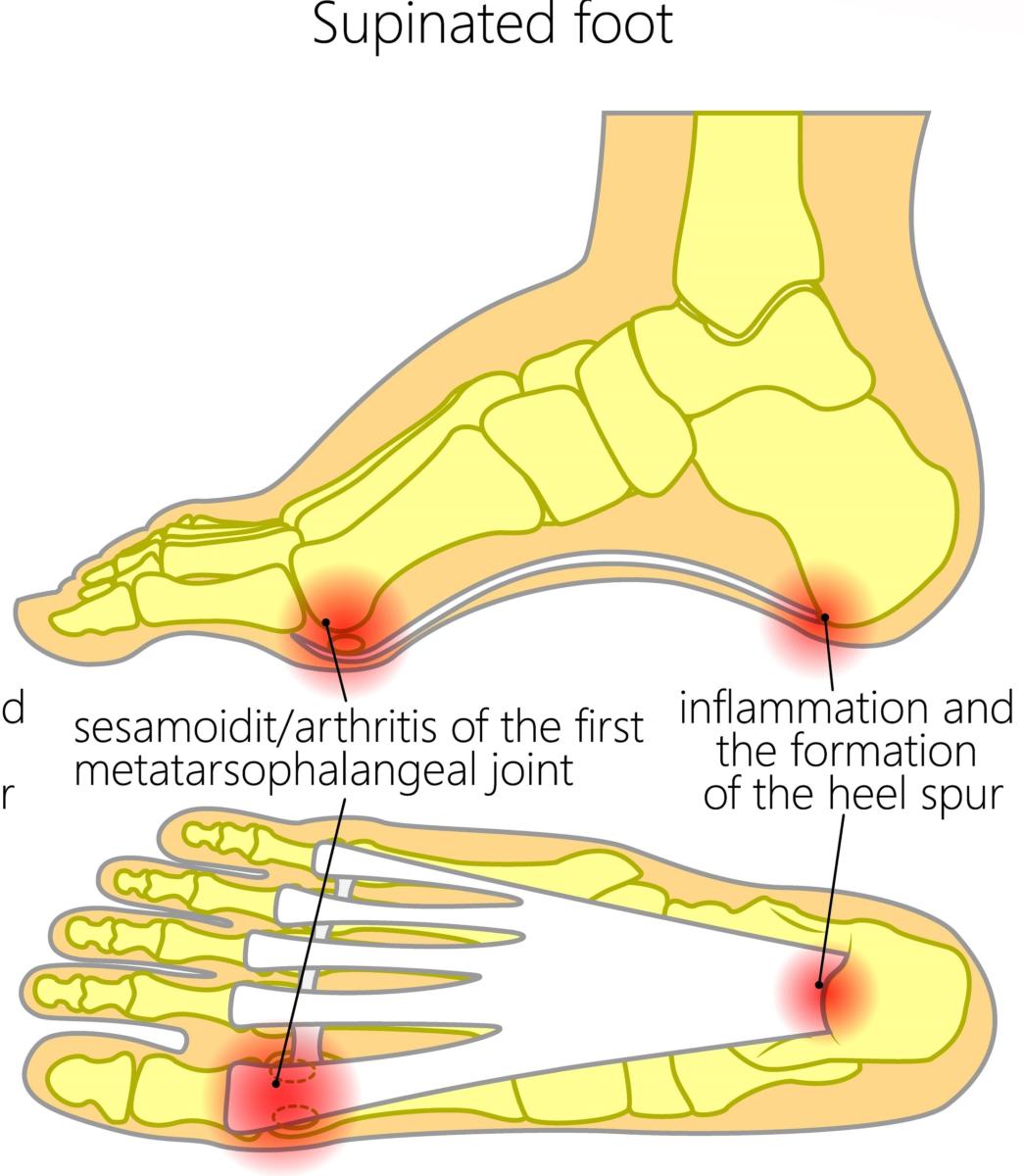 Foot Arch Pain [Causes, Symptoms & Best Home Treatment]