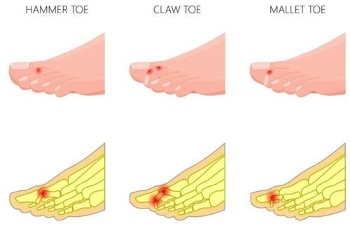 3 types of hammer toe deformities