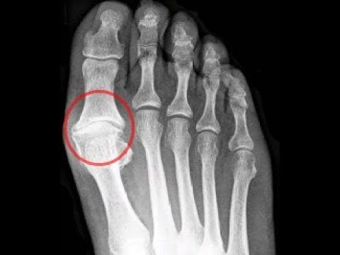 Big toe joint arthritis and ball of the foot pain.