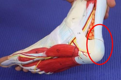 Insertional Achilles tendonitis heel spur pain