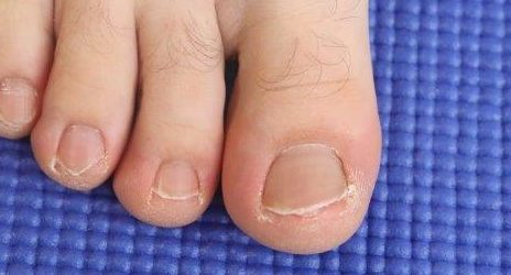 White dry skin after removing toenail polish. Leukonychia.