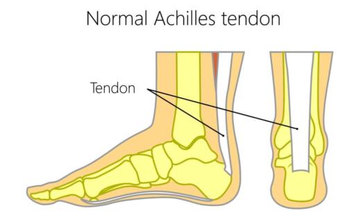 Achilles Tendon