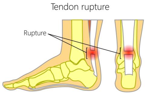 Achilles rupture