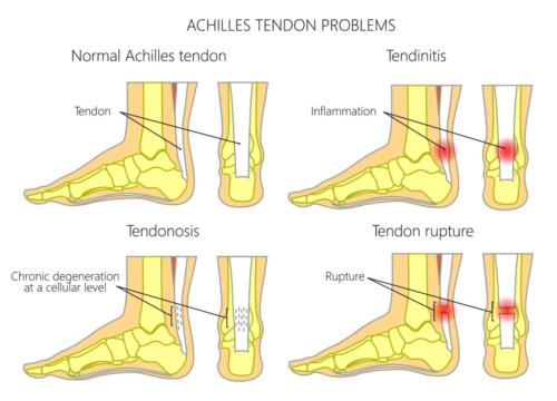 Achilles tendon pictures