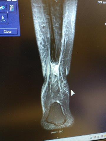 Achilles tendon rupture MRI posterior