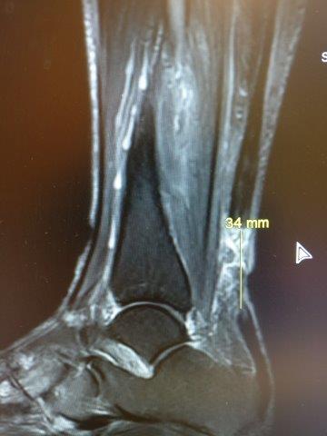 Achilles tendon rupture MRI