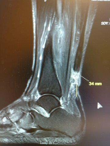 Achilles tendon rupture