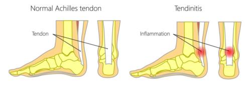 Achilles tendon vs achilles tenonditis