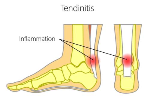 Achilles tendonitis