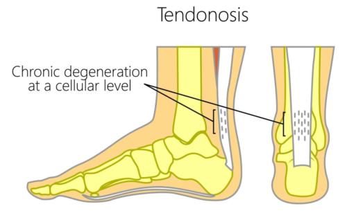 Achilles tendonosis