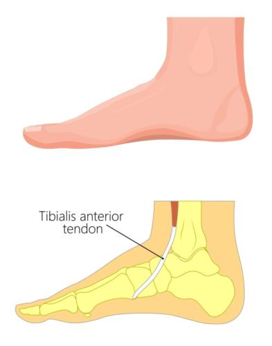 Dorsal Compression Syndrome: [Causes, Symptoms & Best Treatment! ]