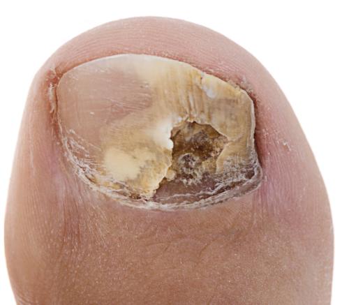 Deep horizontal ridge in the toenail or dent in the toenail.