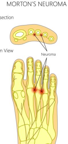 Ball of the foot pain Morton's Neuroma