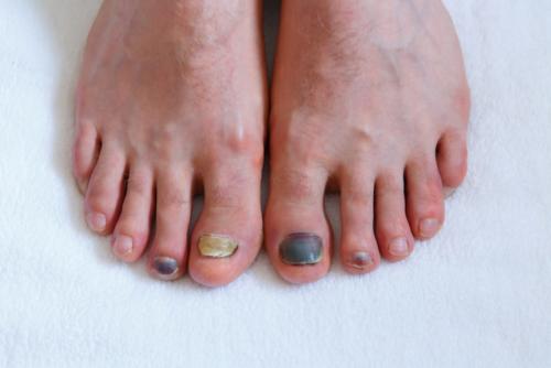 Human male foots with bruised black on toe nails on white background .