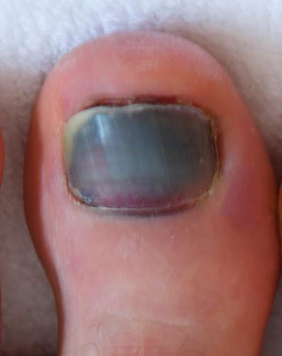 Human male foots with bruised black on toe nails on white background .