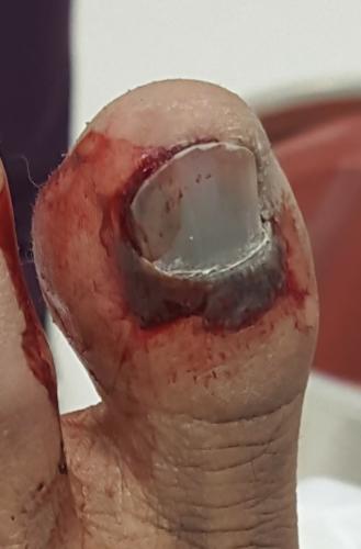 Bleeding big toenail with broken big toe
