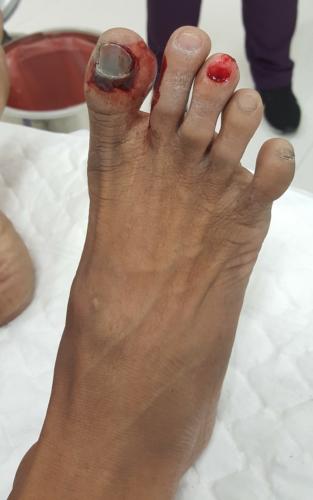 Bleeding black and red toenails