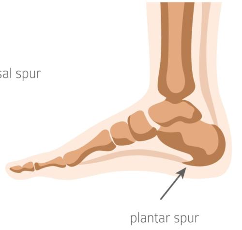 Bottom of the heel spur plantar fasciitis