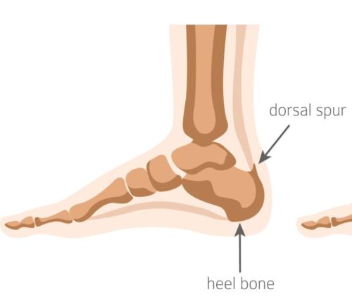 Bottom of the heel spur plantar fasciitis spur