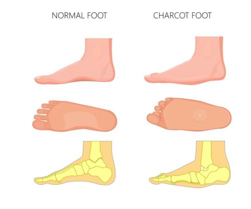Charcot Athropathy Midfoot fracture or collapse