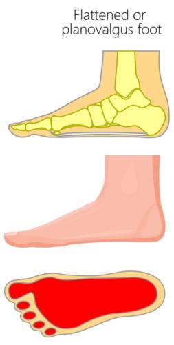 Flat foot overpronation heel pain