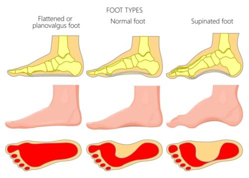 High arched foot vs. flat foot type heel pain