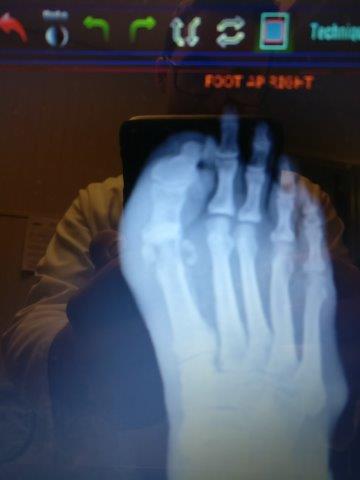 broken and dislocated big toe joint with metatarsal phalangeal joint fracture surgery treatment