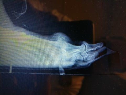 Severe hallux rigidus big toe joint arthritis